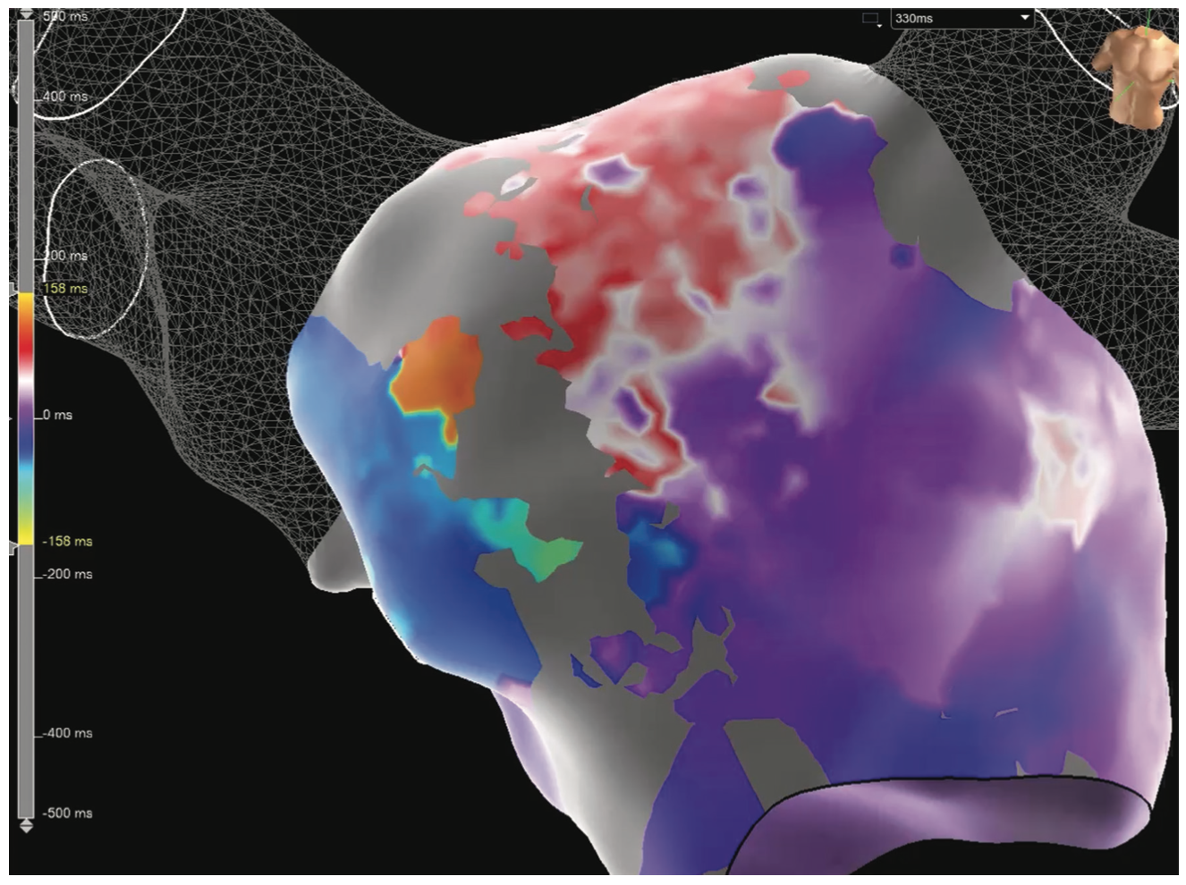 Pillari Atypical Atrial Flutter Figure 6