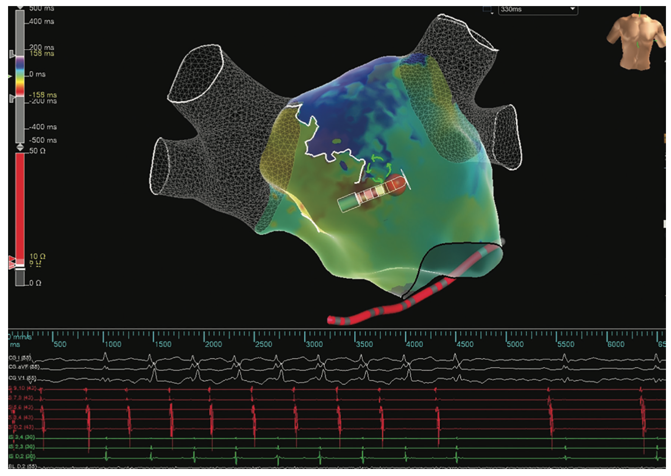 Pillari Atypical Atrial Flutter Figure 7