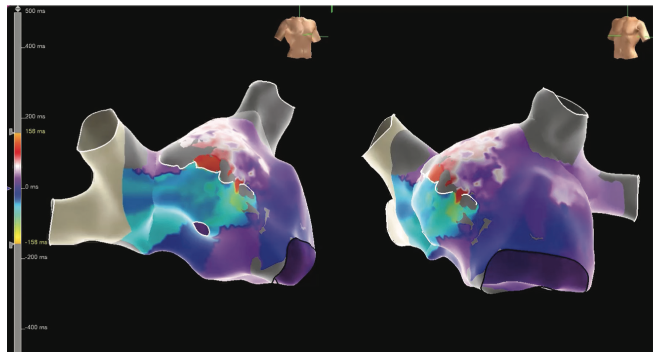 Pillari Atypical Atrial Flutter Figure 8