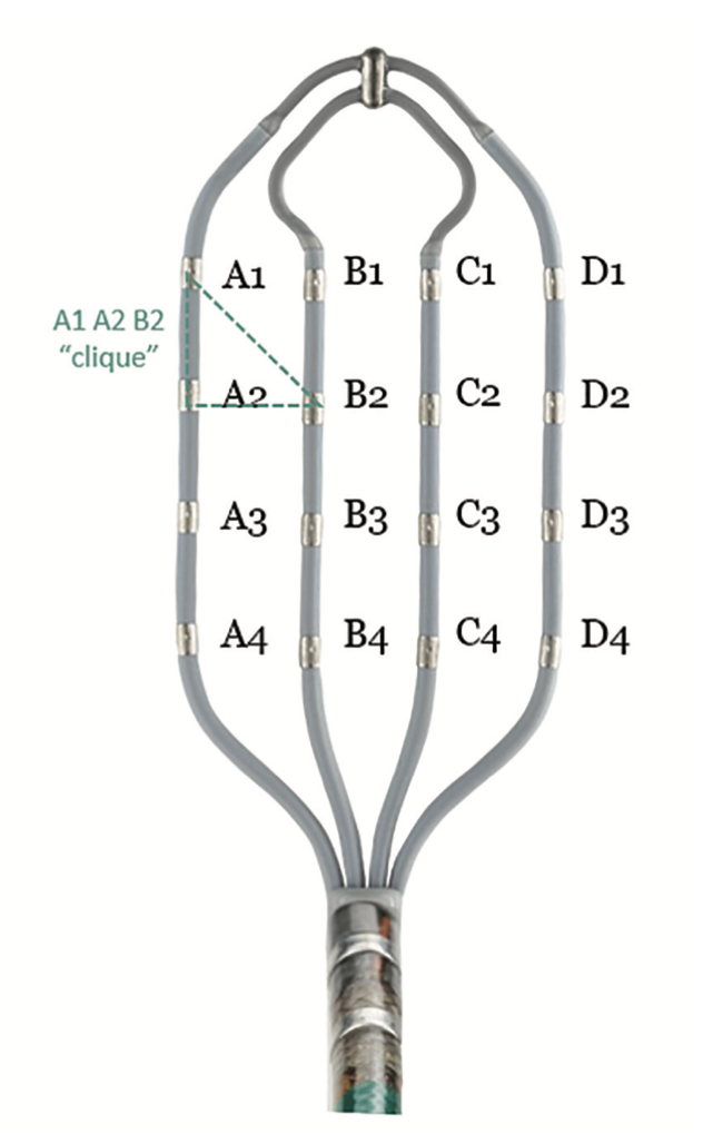 Pillari Atypical Atrial Flutter Figure 9