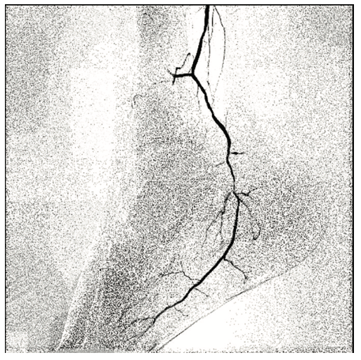 Pistalo Interventional Techniques Figure 1