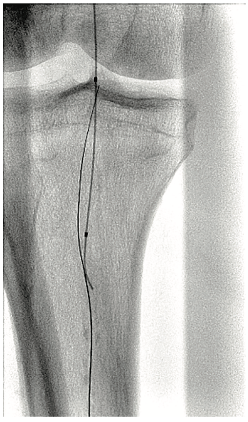Pistalo Interventional Techniques Figure 2