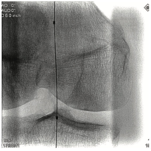 Pistalo Interventional Techniques Figure 3