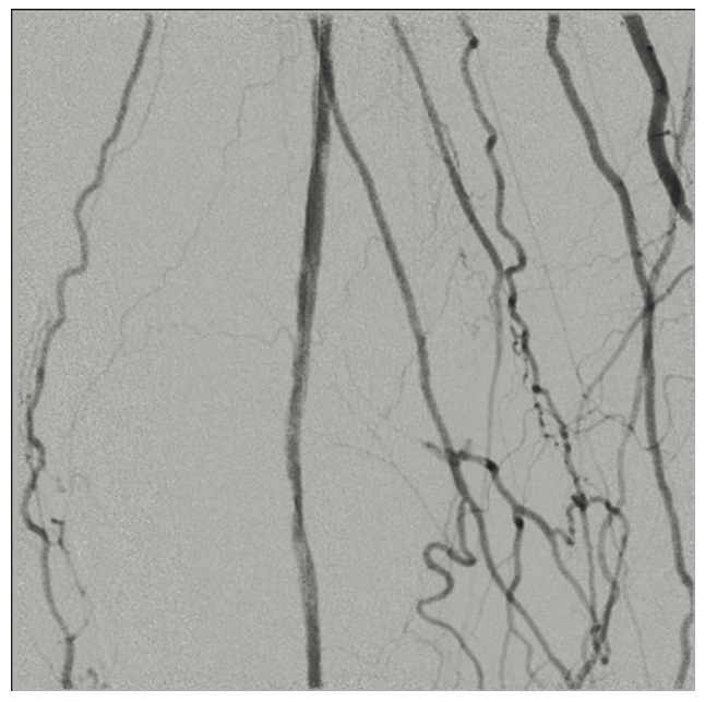 Pistalo Interventional Techniques Figure 4