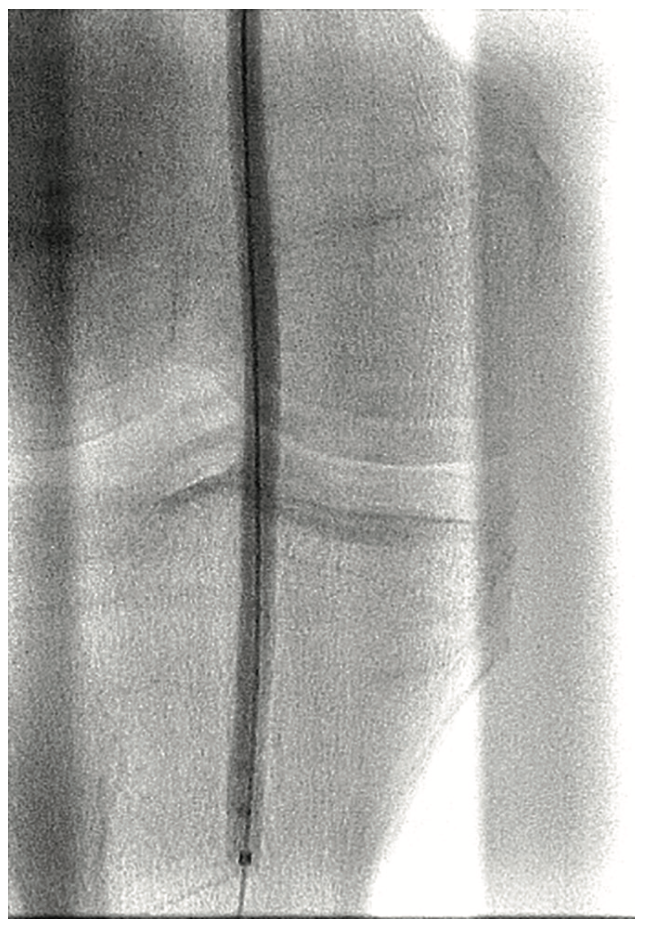 Pistalo Interventional Techniques Figure 5