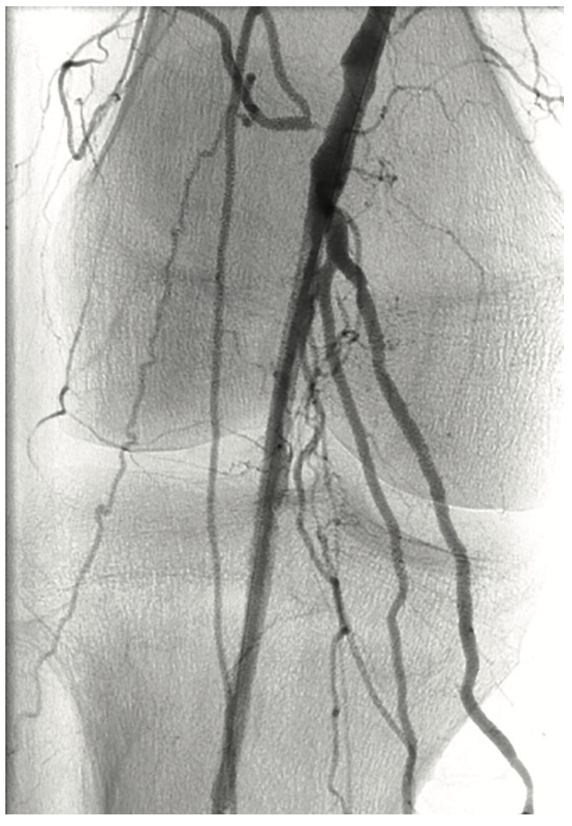 Pistalo Interventional Techniques Figure 6