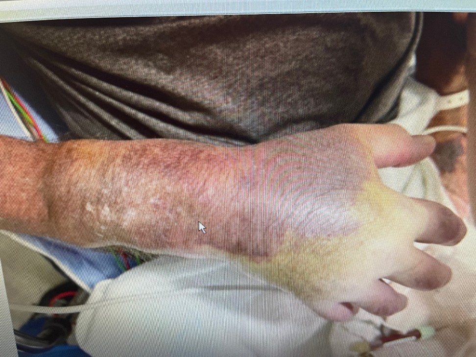 Figure 1. Radial artery pseudoaneurysm