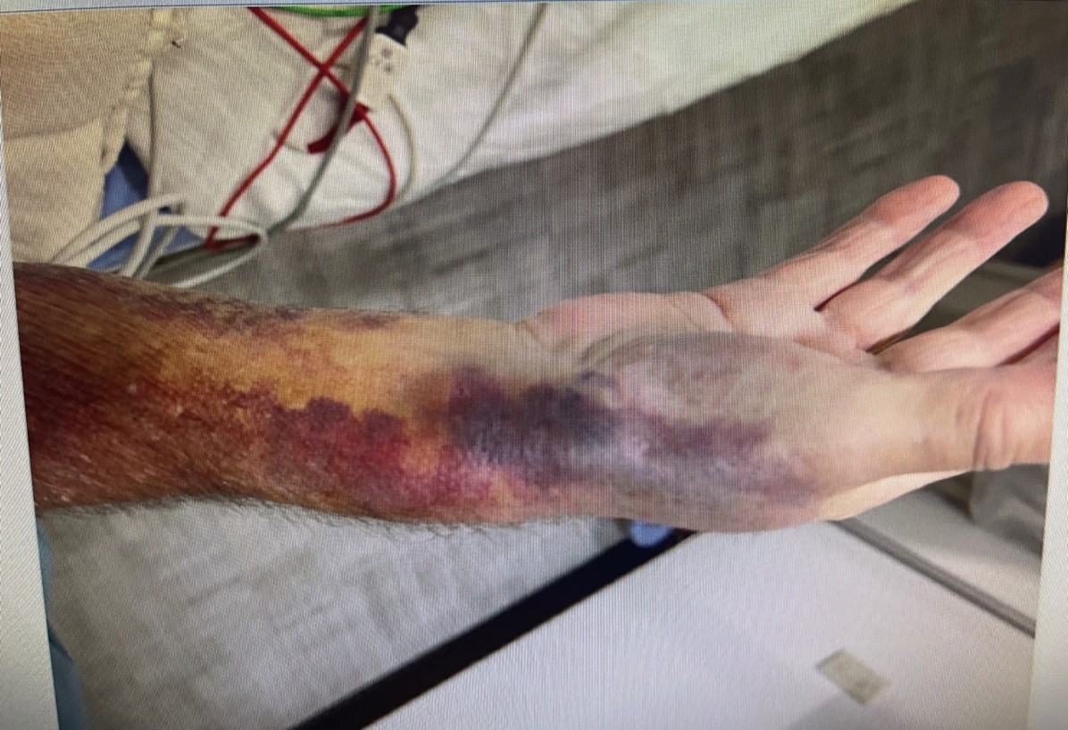 Figure 2. Ruptured pseudoaneurysm.