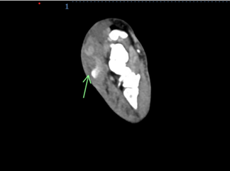 Figure 3A. CTA showing contrast extravasation.