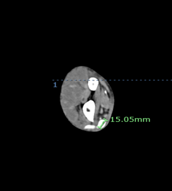Figure 3B. CTA showing 1.5 cm x 1.5 cm PSA after rupture.