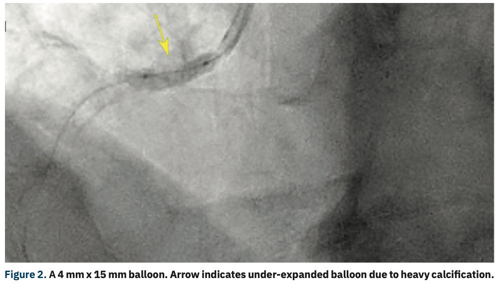 Potluri Stenosis Figure 2