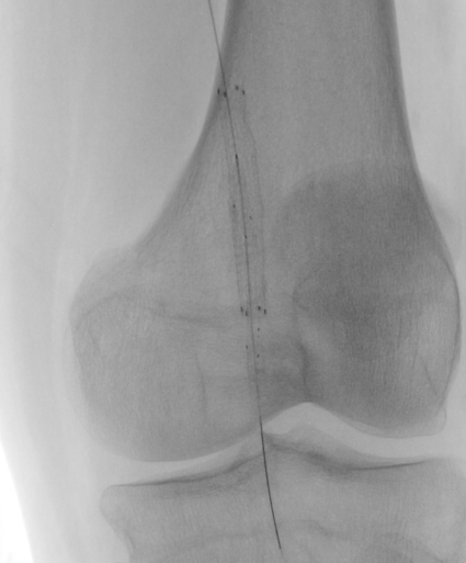 Figure 2. Pounce mechanical thrombectomy system (Surmodics).&nbsp;
