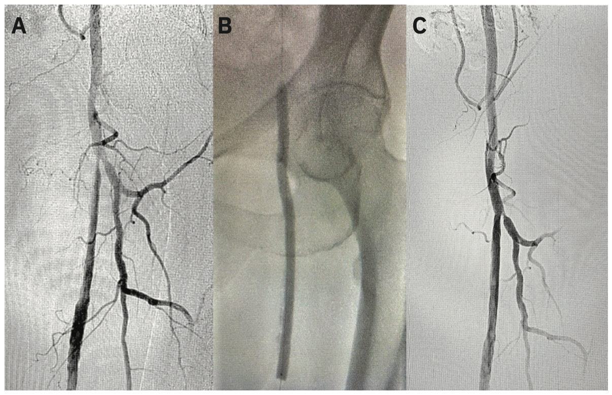 Prasad Bilateral Femoropopliteal Figure 2