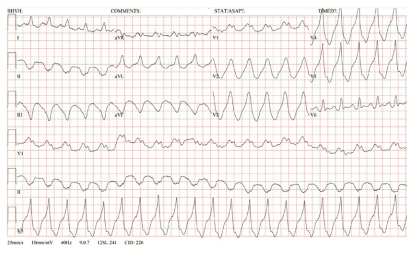 Rao Pacemaker Figure 1