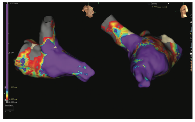 Rao Pacemaker Figure 10