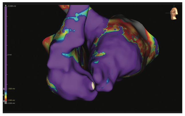 Rao Pacemaker Figure 11
