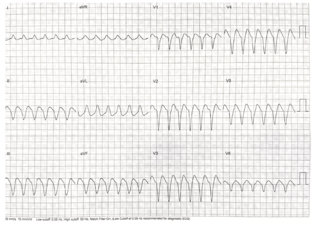 Rao Pacemaker Figure 12