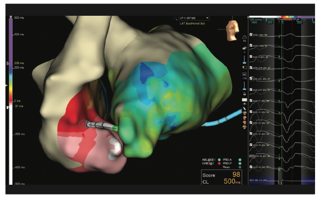 Rao Pacemaker Figure 14