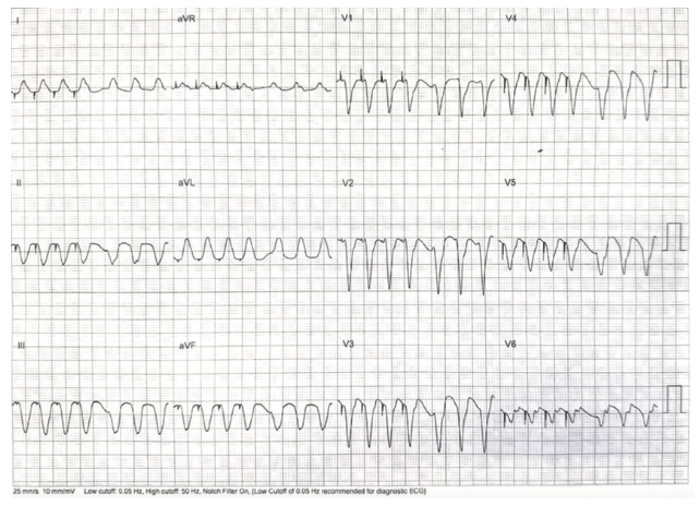 Rao Pacemaker Figure 15