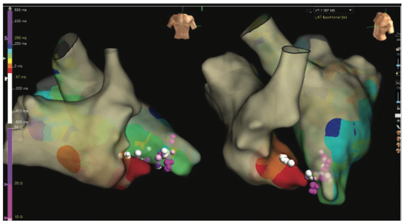 Rao Pacemaker Figure 16