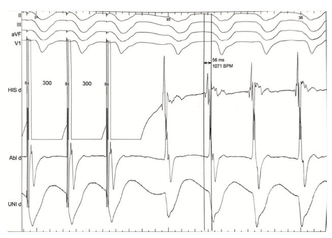 Rao Pacemaker Figure 17