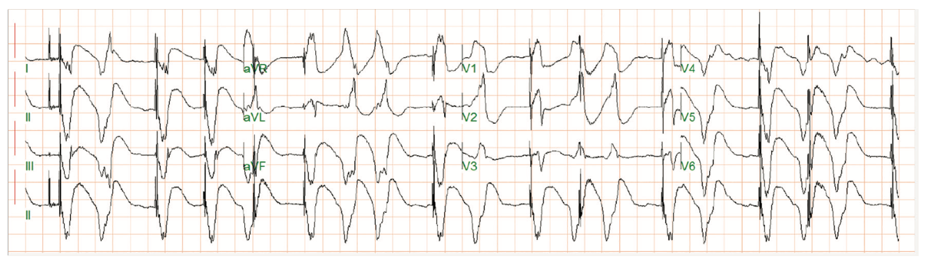 Rao Pacemaker Figure 18