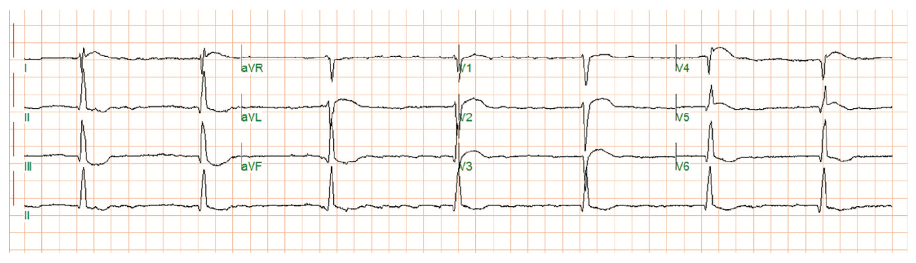 Rao Pacemaker Figure 19
