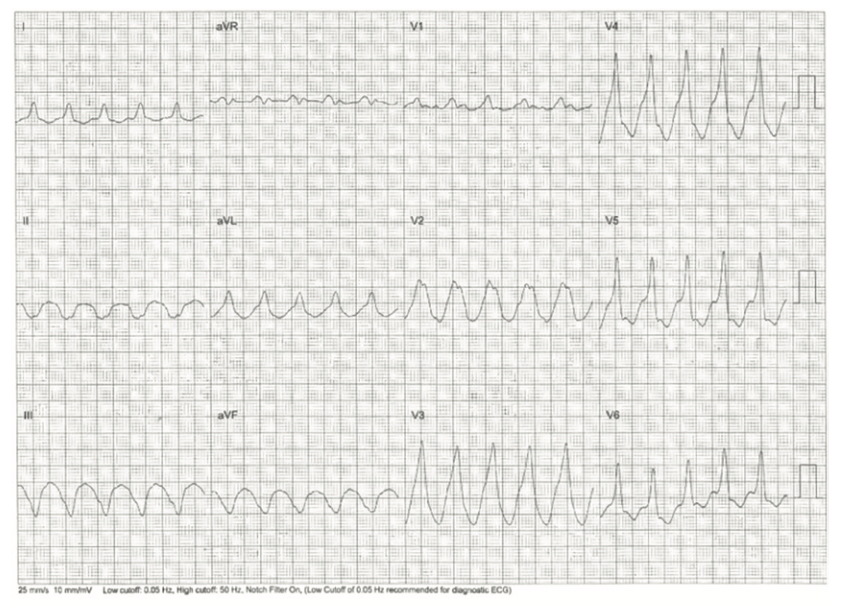 Rao Pacemaker Figure 2