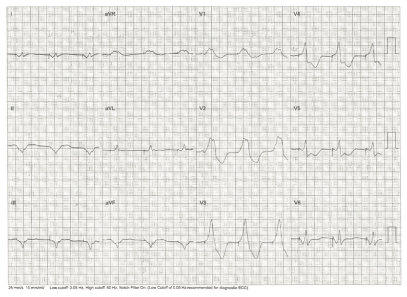 Rao Pacemaker Figure 3