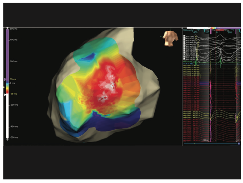 Rao Pacemaker Figure 4