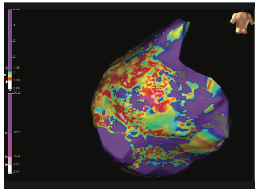 Rao Pacemaker Figure 6