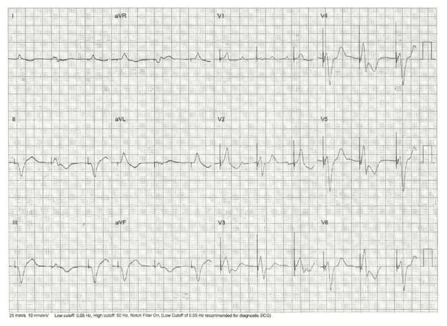 Rao Pacemaker Figure 9