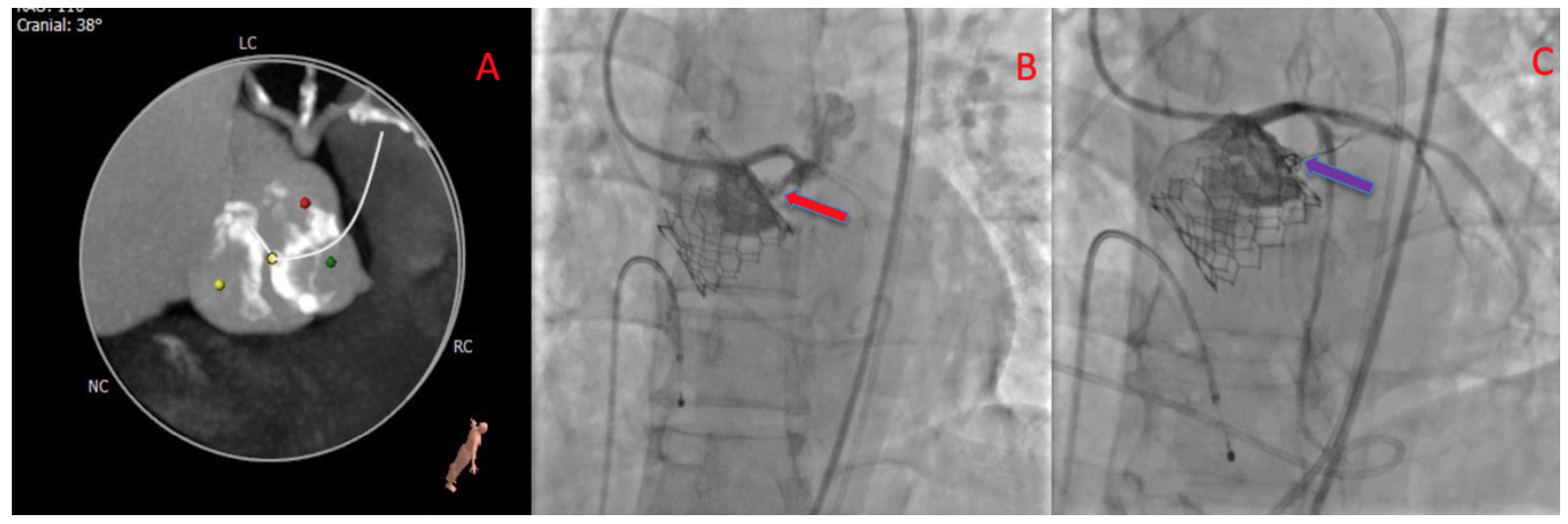 Rao TAVR Figure 1
