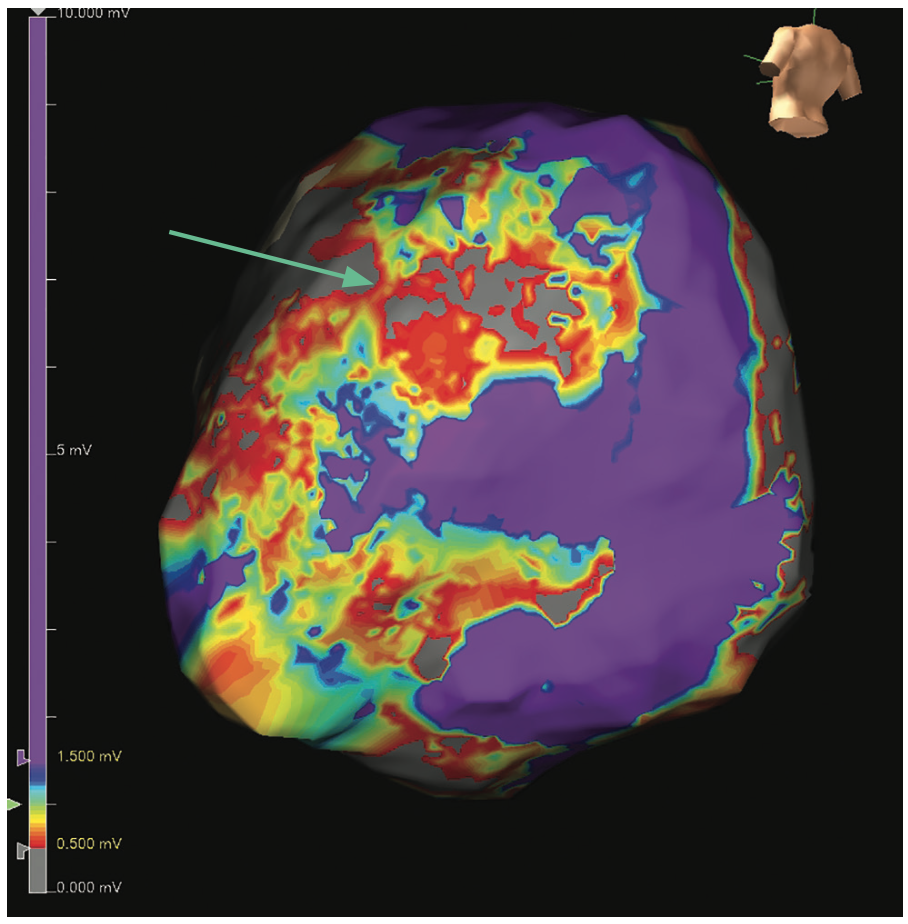 Rao Ventricular Tachycardia Figure 1