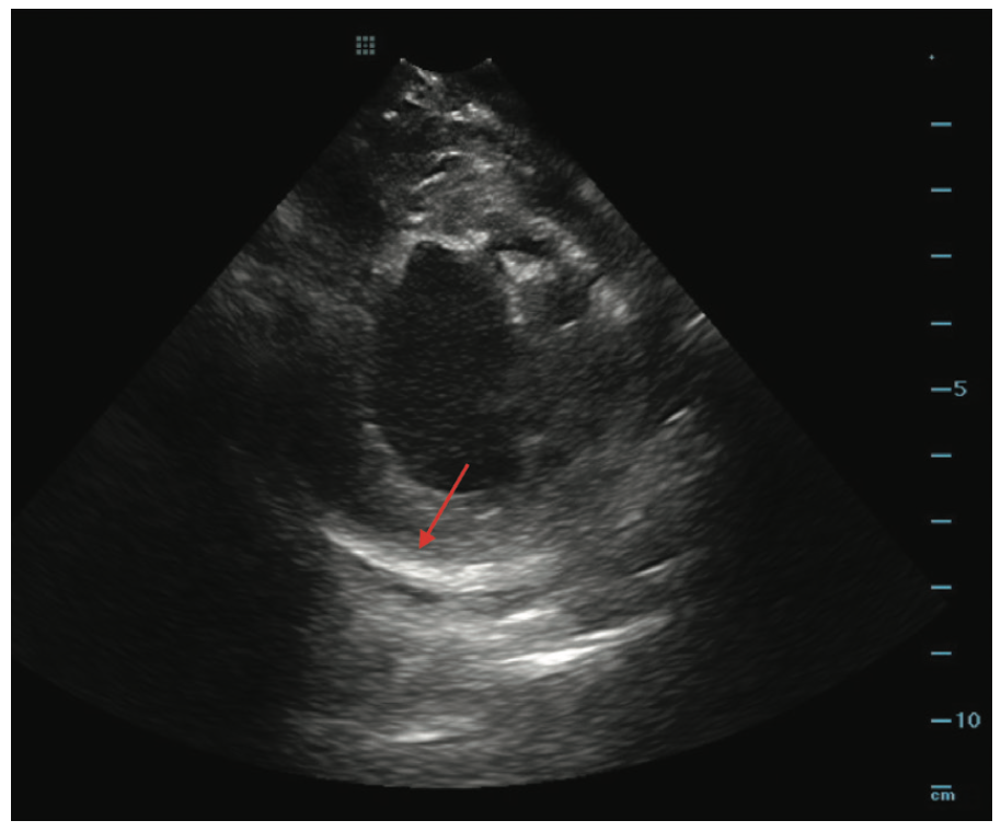 Rao Ventricular Tachycardia Figure 2