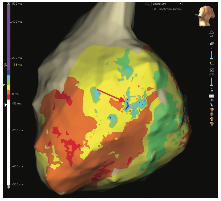 Rao Ventricular Tachycardia Figure 3