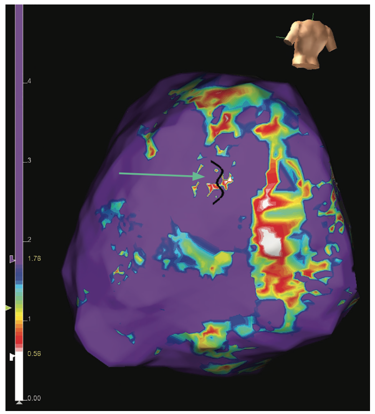 Rao Ventricular Tachycardia Figure 4