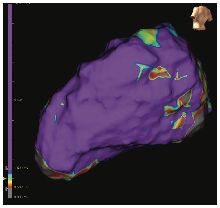Rao Ventricular Tachycardia Figure 5