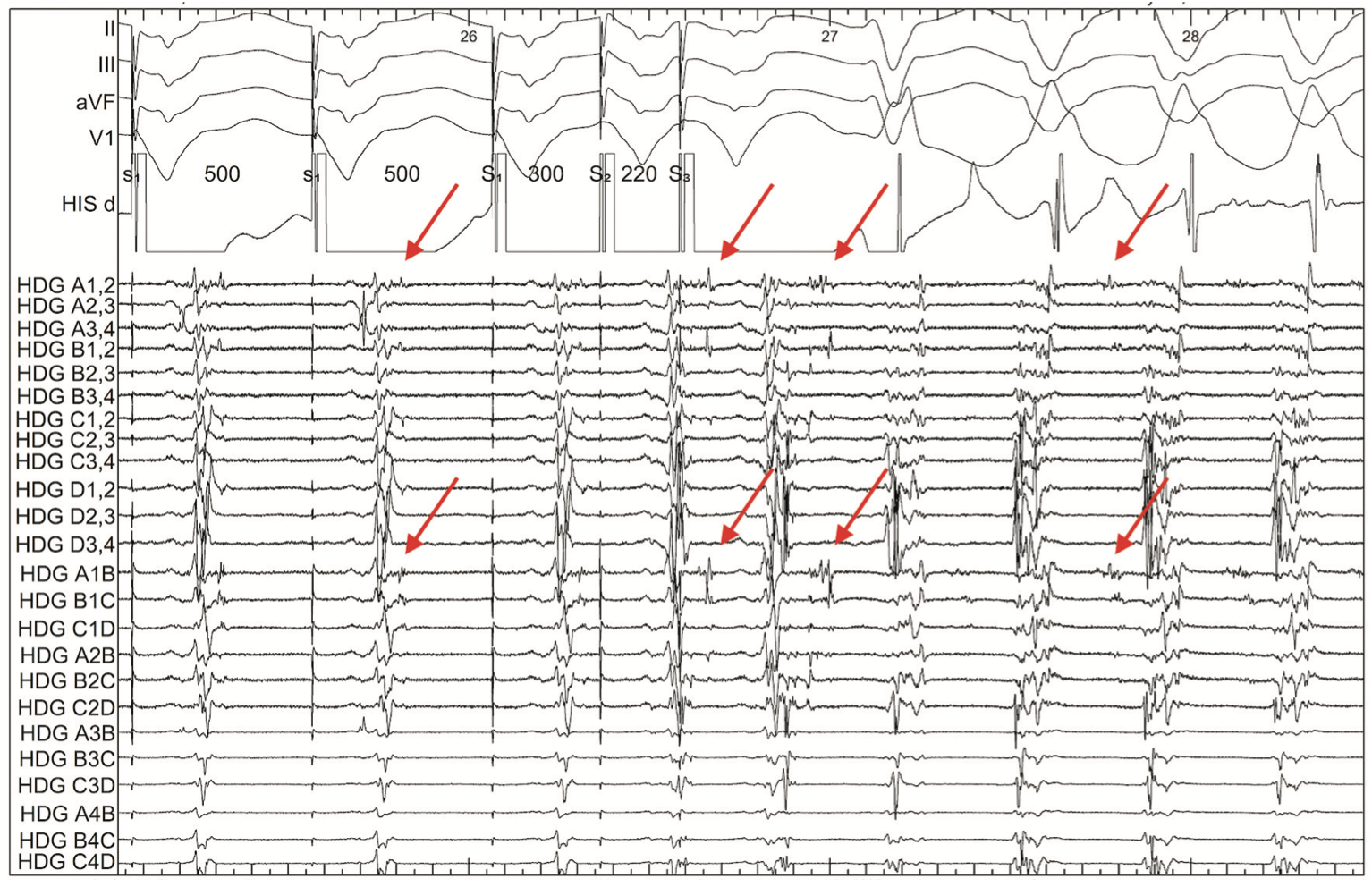 Rao Ventricular Tachycardia Figure 6