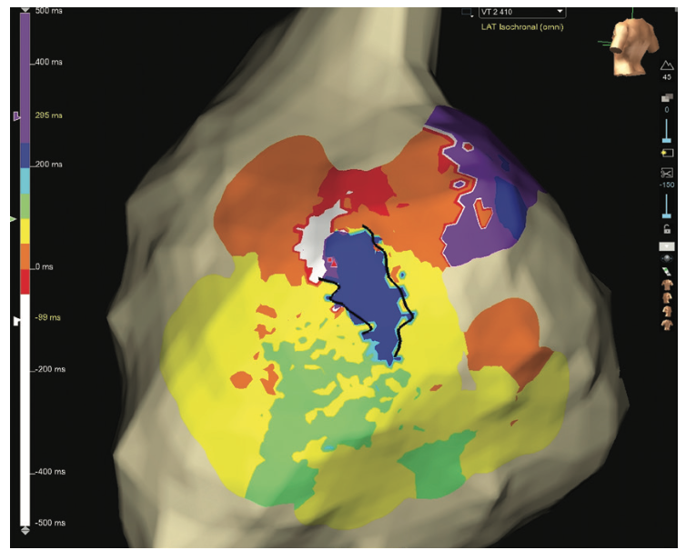 Rao Ventricular Tachycardia Figure 7