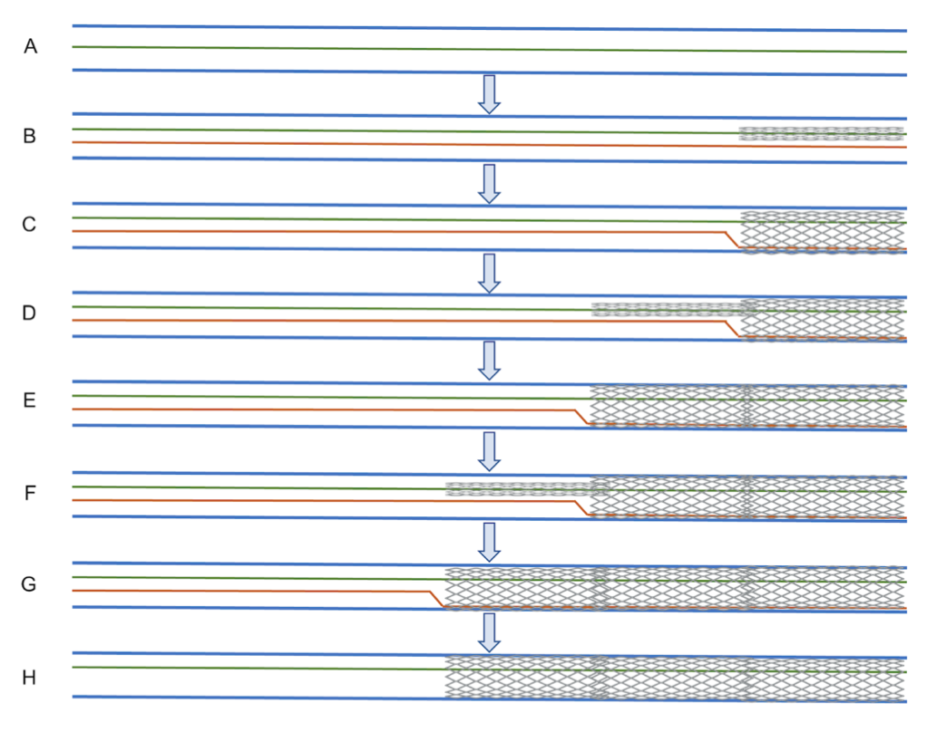 Rath Buddy Wire Technique Figure S1