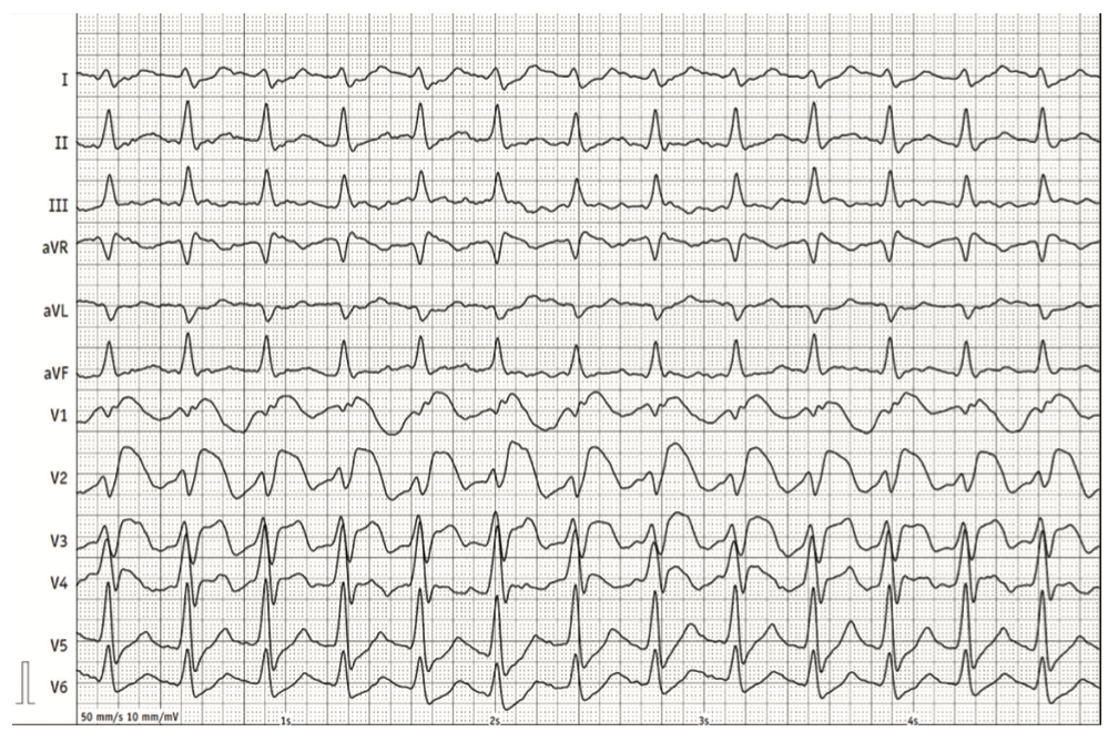 Renz Brugada Phenocopy Figure 1