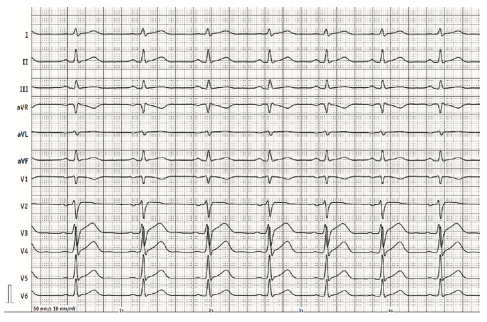 Renz Brugada Phenocopy Figure 2