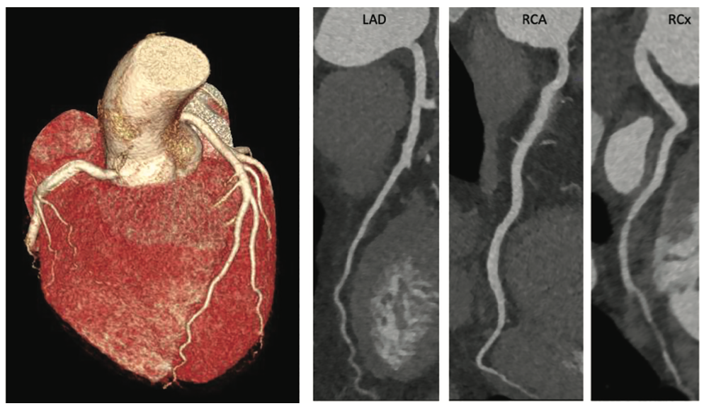 Renz Brugada Phenocopy Figure 3 and 4