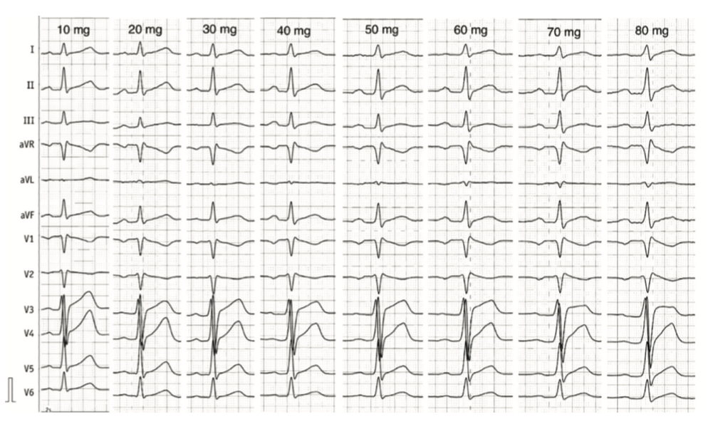 Renz Brugada Phenocopy Figure 5