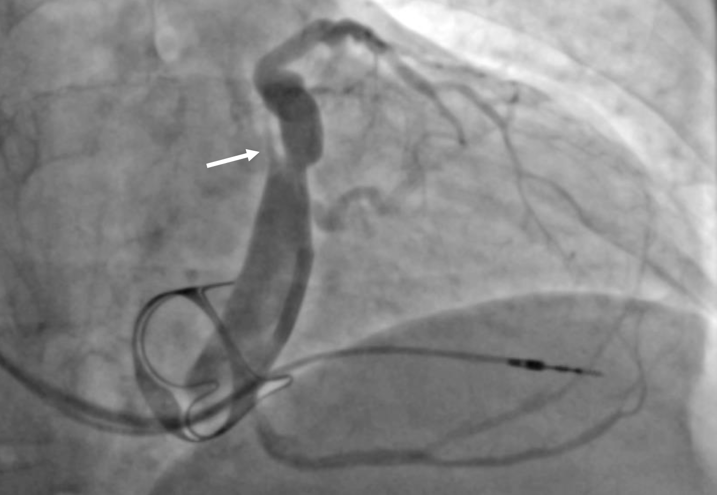 Figure 2: A large vein of Marshall (white arrow) as seen on venography in the right anterior oblique (RAO) fluoroscopic view.