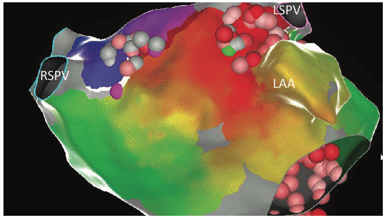 Richardson Ablation Figure 5