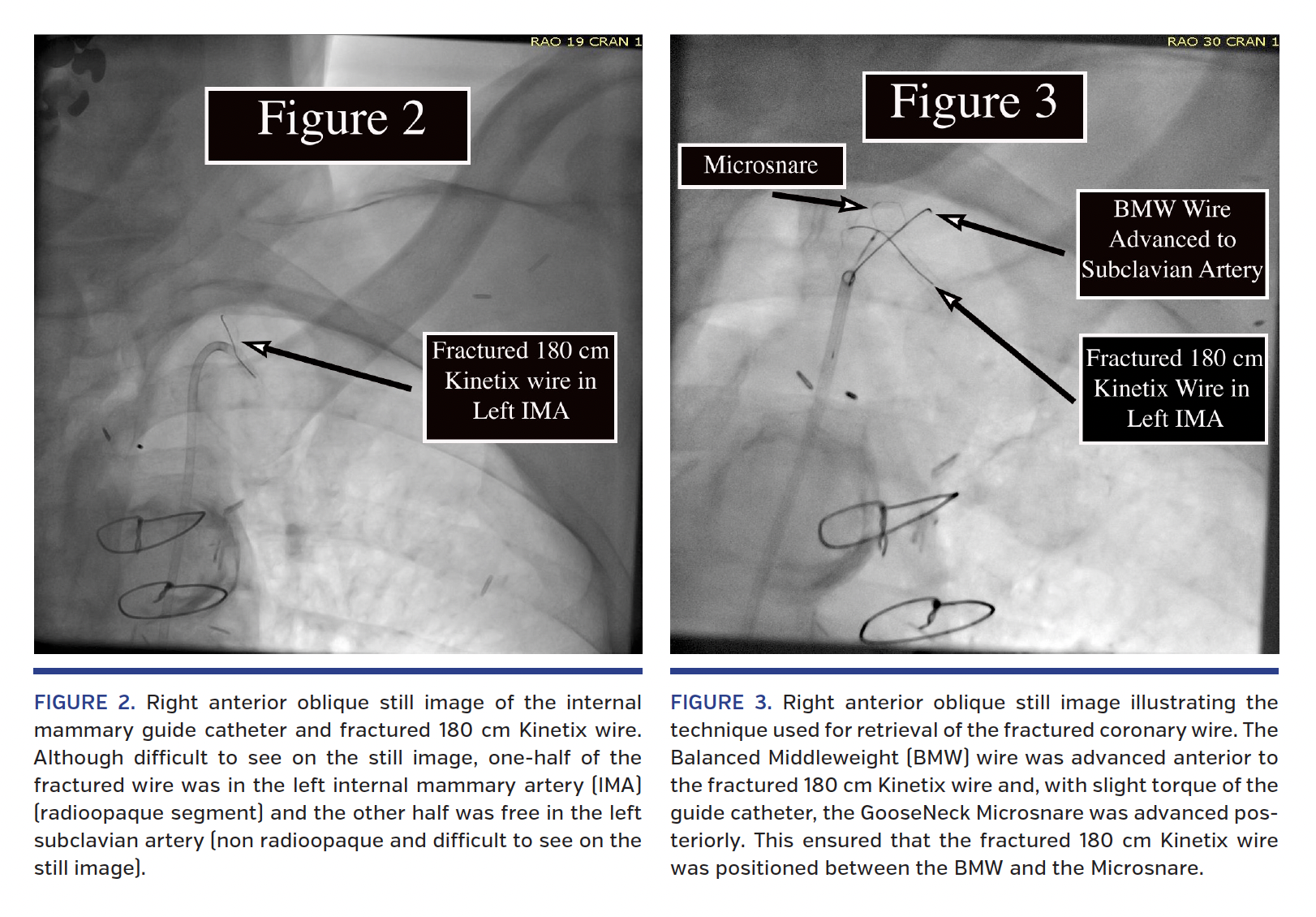 Right anterior oblique still image.png