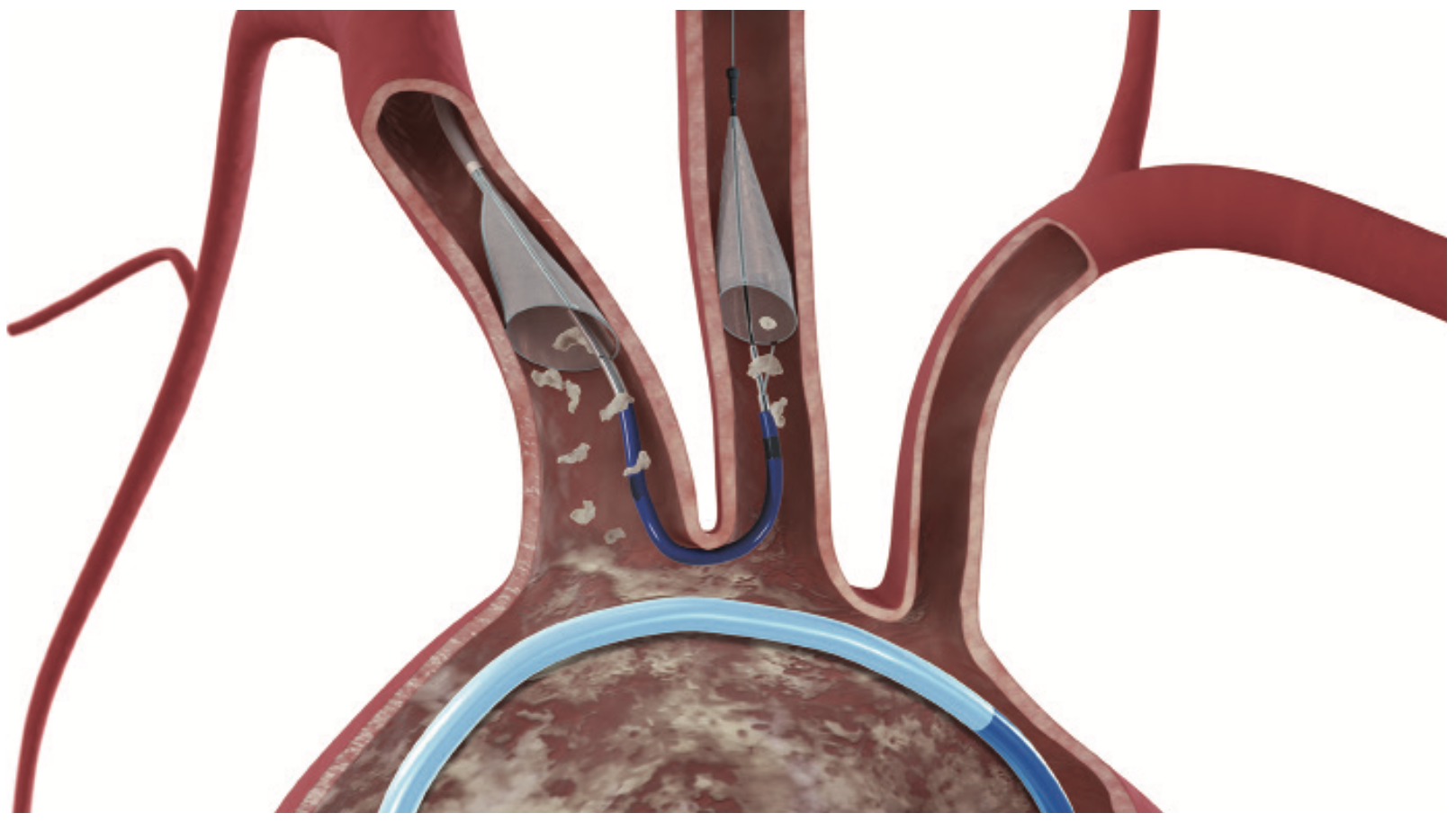 Rinaldi TAVR Figure 1