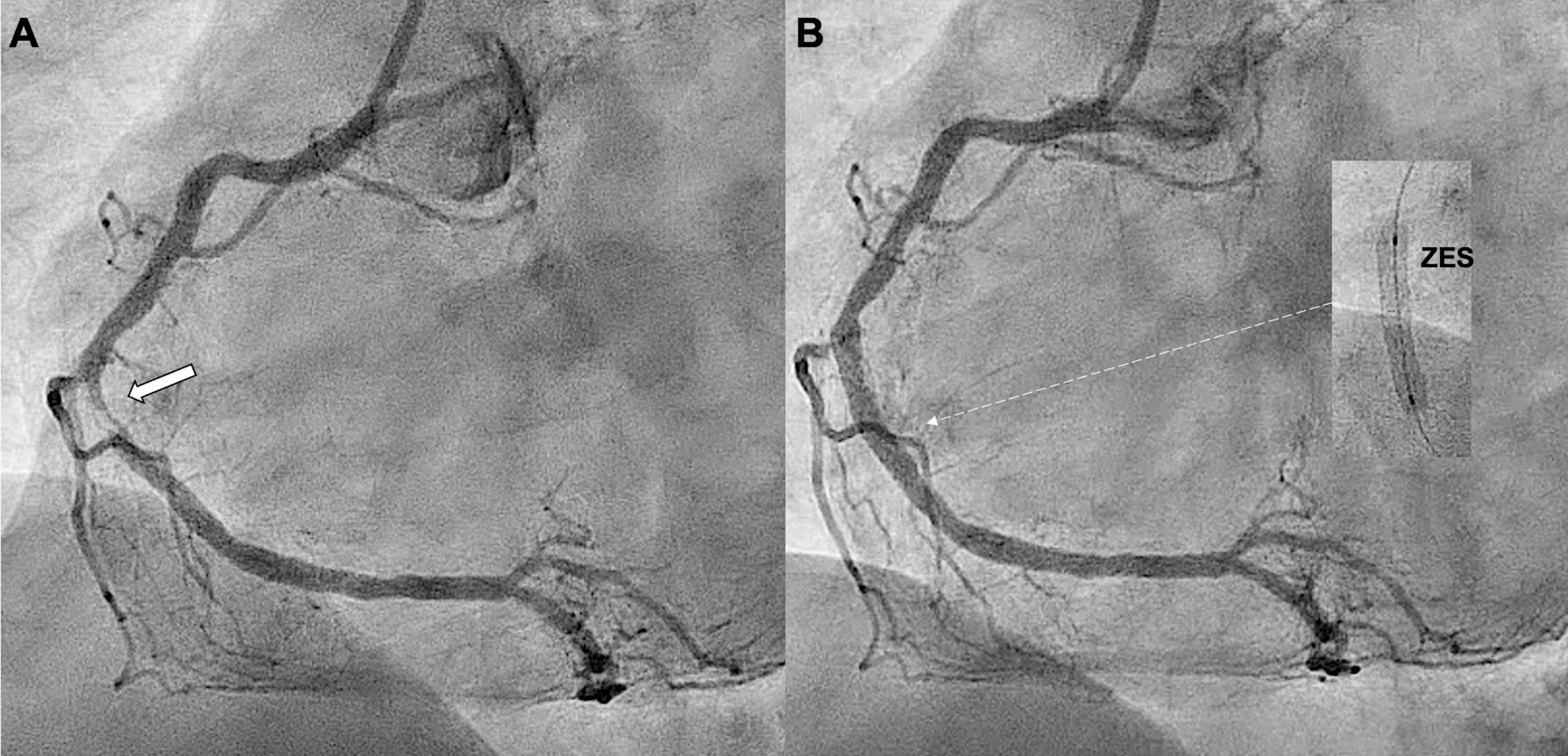 Figure 1. Index coronary angiography